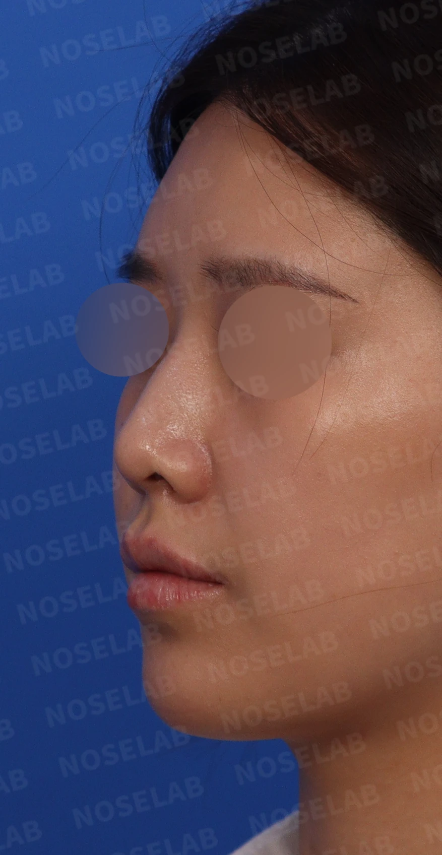 돌출입과 비순각을 함께 살펴보는 코성형 계획 — 수술전 디자인 상담 정면, 좌측 비스듬한 측면, 측면 사진입니다.