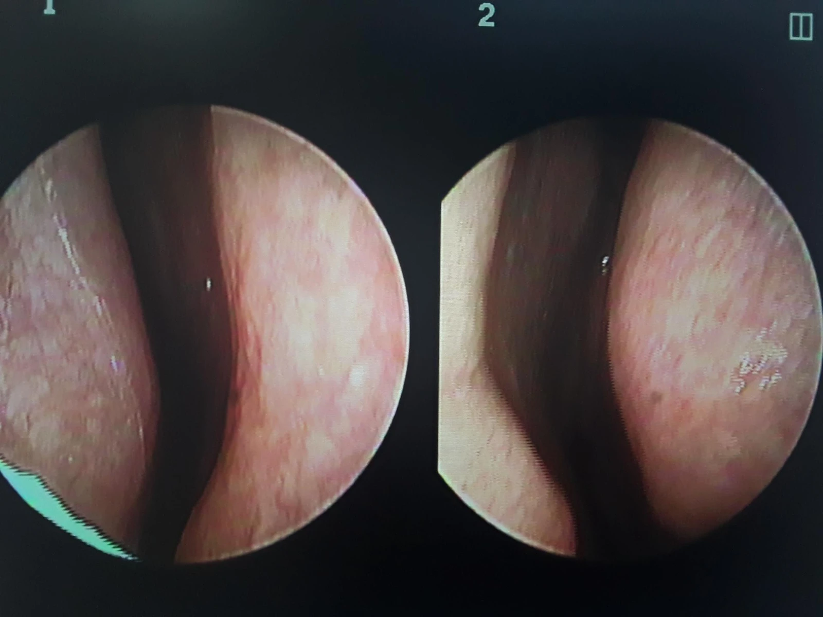 양악수술 뒤 코가 휘고 코끝이 뭉툭해지는 이유, 자가 늑연골로 매부리 라인을 만드는 방법 — 코 내시경 사진입니다. 우측으로 비중격 만곡증이 보이고 양측 하비갑개 비대 소견을 볼 수 있습니다.