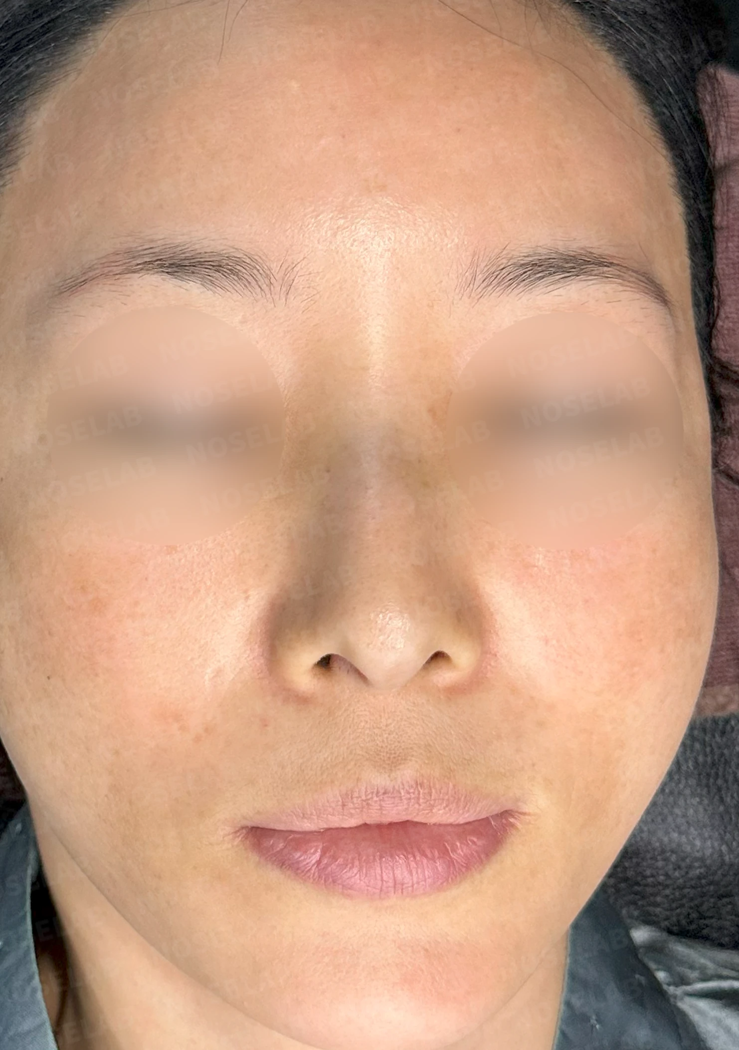 안면비대칭을 고려한 휜코 교정 방법 — 수술 전 / 수술 직후 0일 직후 사진은 부기가 있는 상태로 최종 결과와 다를 수 있습니다.
