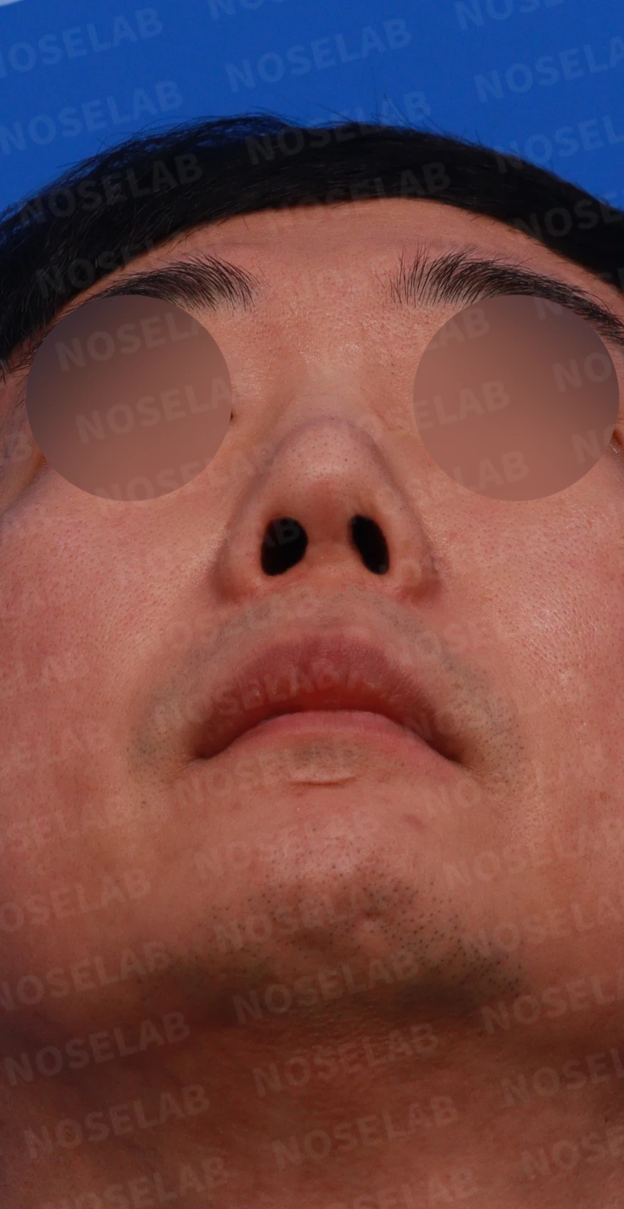 매부리코 수술 후 비대칭의 재수술 방법 — 디자인 상담 우측 비스듬한 측면, 측면, 비공 사진입니다.