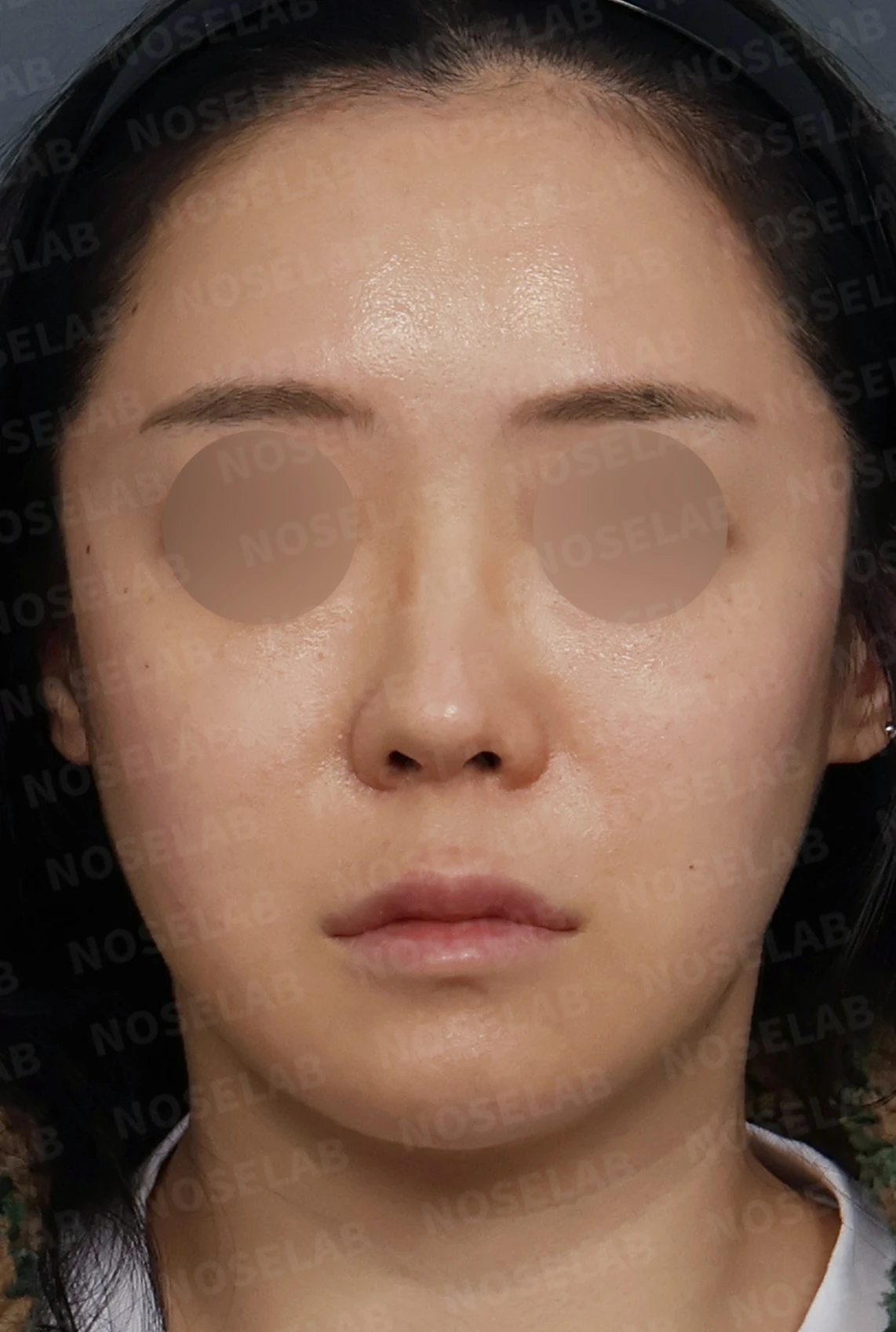들린코 교정과 코막힘 개선, 자가늑연골로 코재수술 후기 — 디자인 상담 정면, 좌측 측면, 비스듬한 측면 사진입니다.