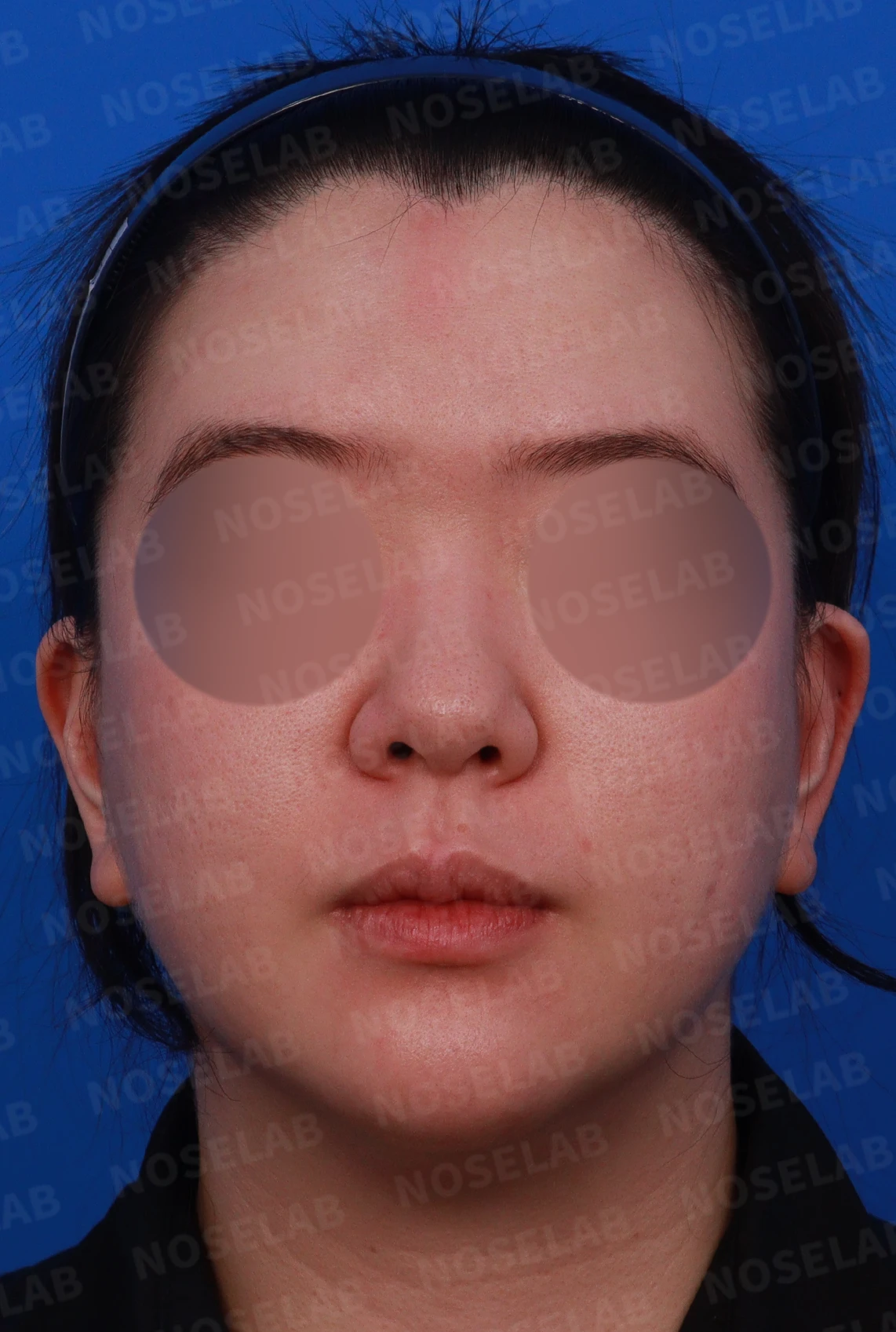 코끝이 퍼지고 입체감이 없어 보이는 이유, 복코 교정은 어떻게 하나 — 디자인 상담 정면, 좌측 측면, 비스듬한 측면 사진