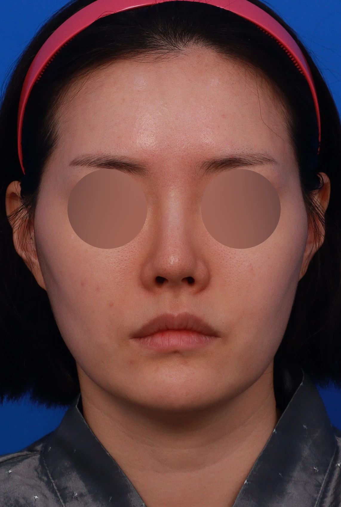 코끝이 비치는 이유와 코끝 포인트를 낮추는 교정 방법 — 디자인 상담 정면, 비스듬한 측면 사진,좌측 측면