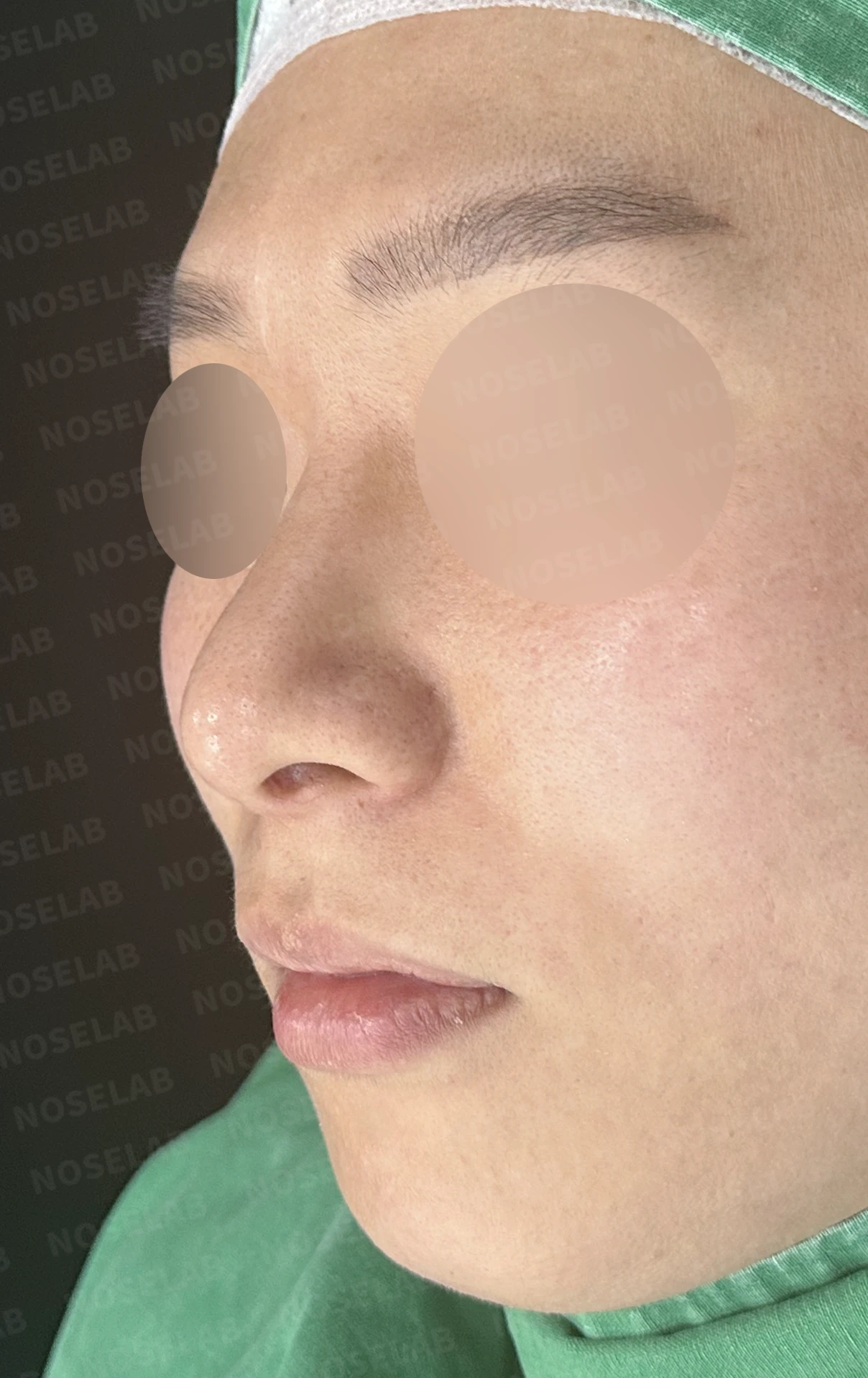 한쪽 비골이 함몰되면 왜 코가 휘어 보이는가, 절골 복원과 비중격 재건 — 수술 전 / 수술 직후 0일 직후 사진은 부기가 있는 상태로 최종 결과와 다를 수 있습니다.