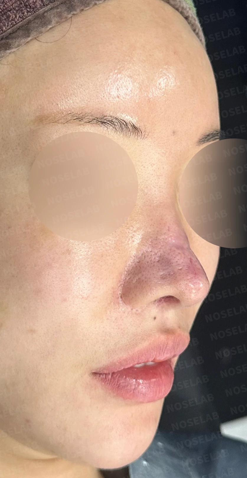 코 수술 뒤 콧등 피부가 괴사하면 어떤 변화가 남고, 재건은 어떻게 하나 — 수술 전 / 수술 직후 0일 직후 사진은 부기가 있는 상태로 최종 결과와 다를 수 있습니다.
