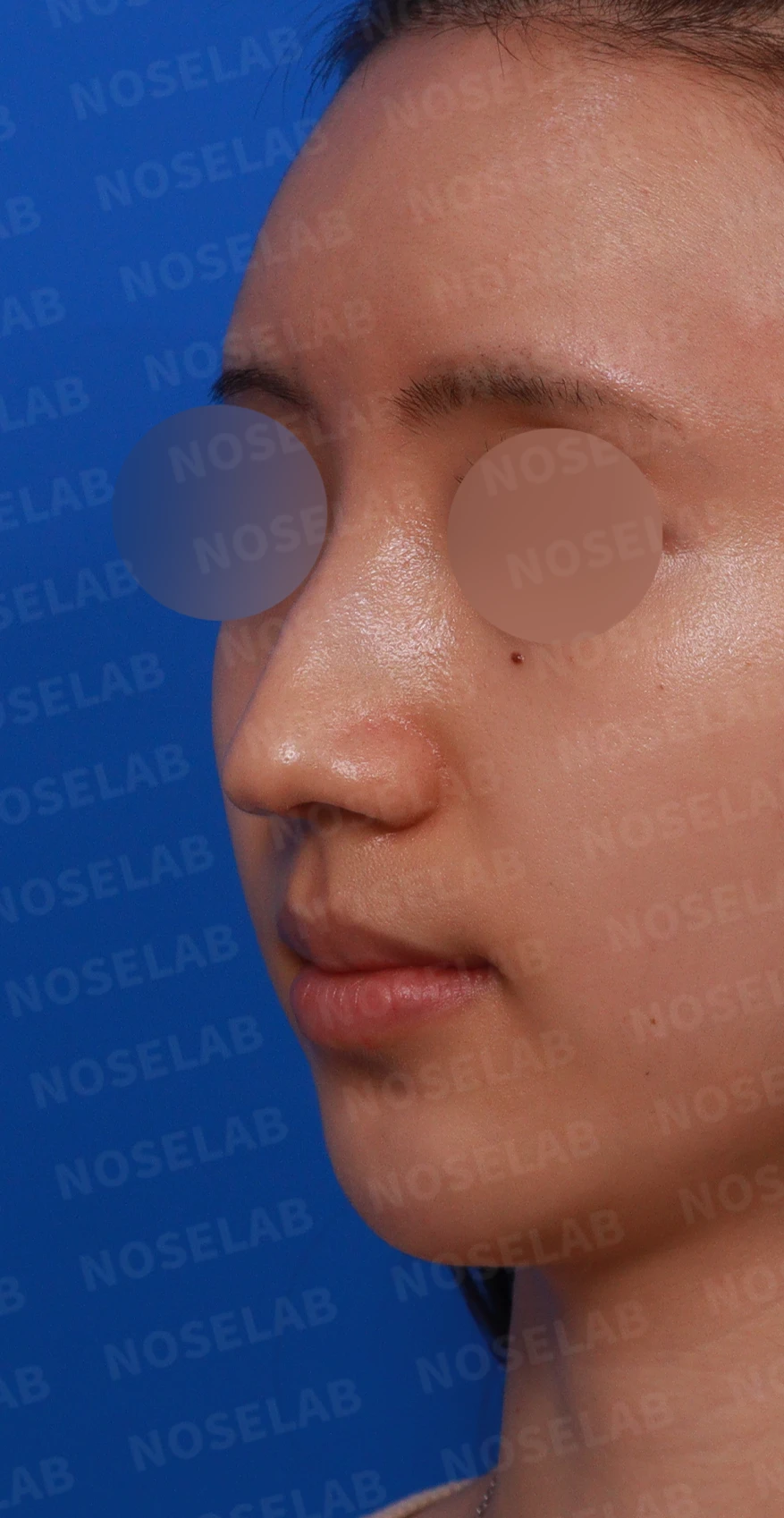 매부리코와 긴 코에 코막힘이 겹치는 이유, 교정은 어떻게 하나 — 디자인 상담 정면, 좌측 측면, 비스듬한 측면 사진입니다.