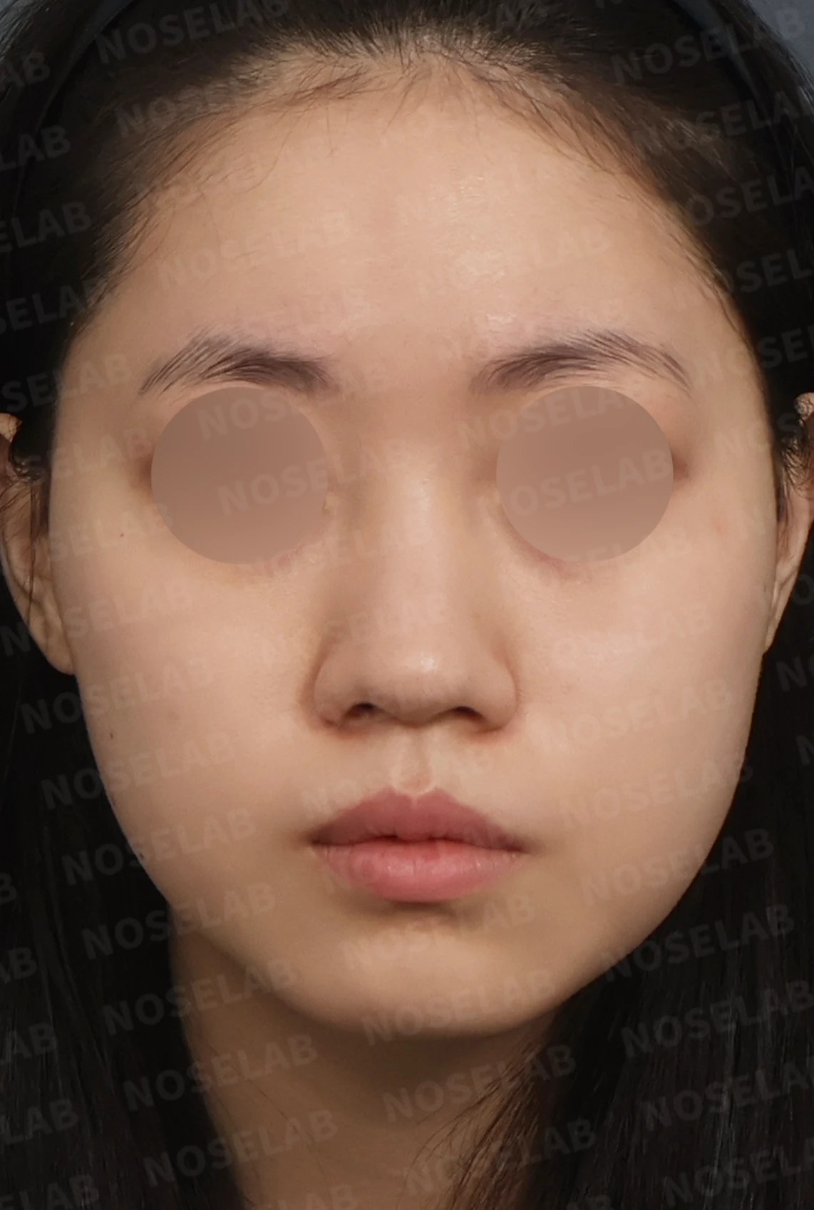 복코와 주먹코, 자가늑연골로 얄쌍하고 여성스러운 코 완성 — 디자인 상담 정면, 좌측 측면, 비스듬한 측면 사진입니다.