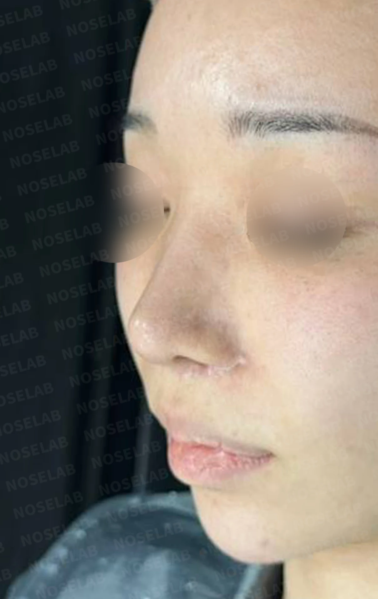 콧구멍 비대칭과 협착이 생기는 이유, 늑연골 재건과 Z성형은 어떻게 하나 — 수술 전 / 수술 직후 0일 직후 사진은 부기가 있는 상태로 최종 결과와 다를 수 있습니다.