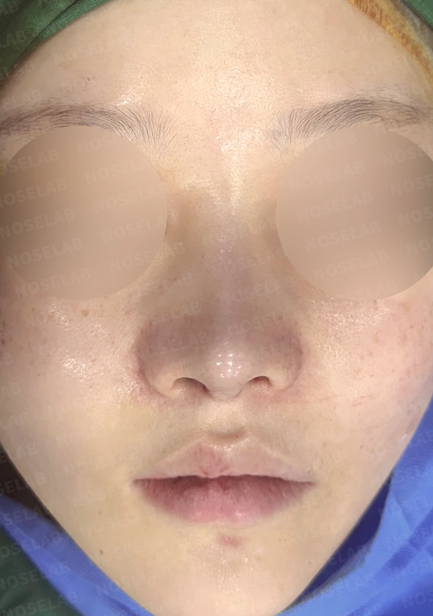 휘어진 코와 복코, 자가늑연골 비중격 재건으로 안전하게 교정한 코재수술 — 직후 정면, 비스듬한 측면, 측면 사진입니다.