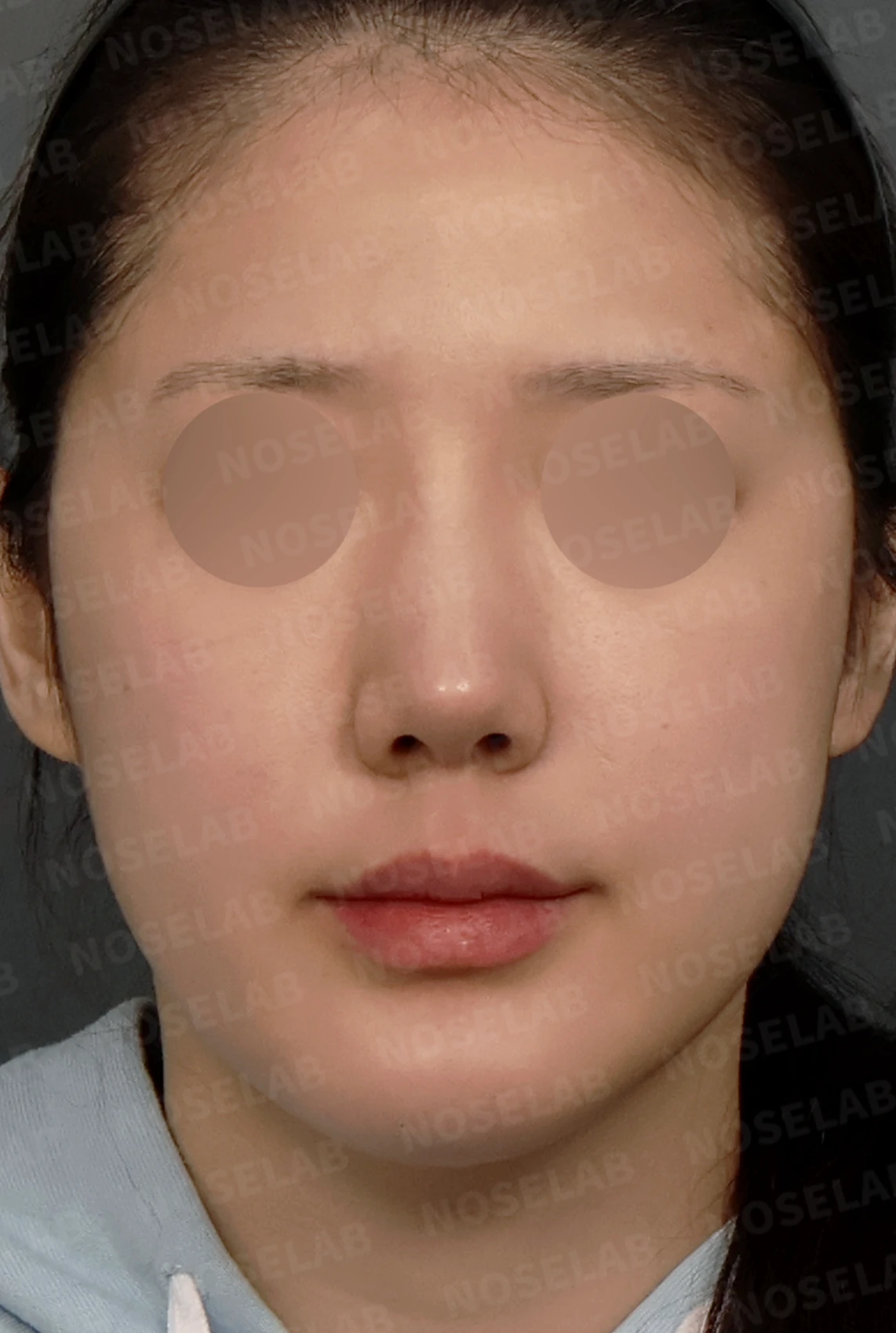 코재수술, 휘어진 코뼈와 매부리코를 외측 절골술과 자가늑연골로 자연스럽게 교정 — 디자인 상담 정면, 좌측 측면, 비스듬한 측면 사진입니다.