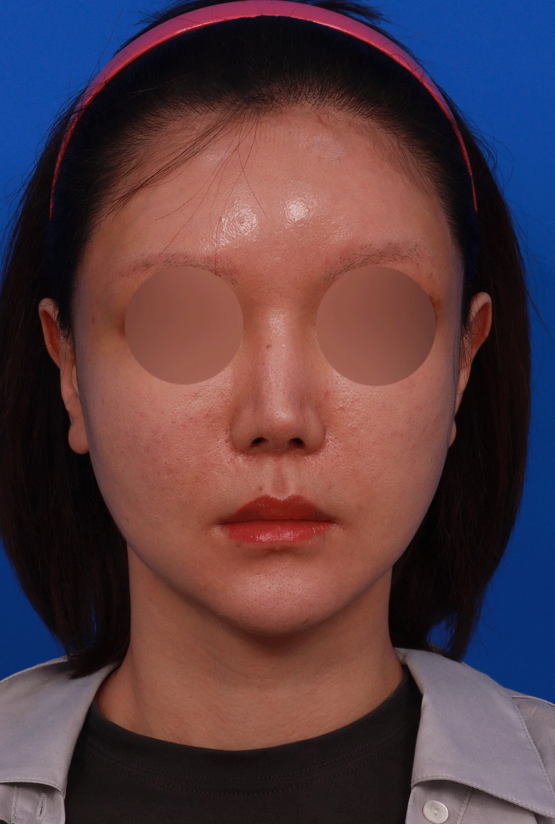 여러 차례 재수술로 코에 쓸 연골이 남지 않았을 때, 재건은 어떻게 하나 — 디자인 상담 정면 , 좌측 비스듬한 측면 , 측면 사진 입니다.