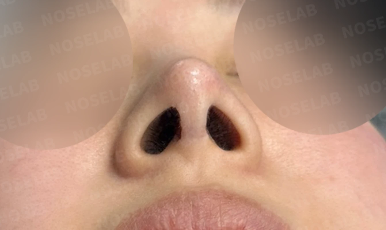 뾰족한 코끝과 연골 비침 - 자가진피 코 재수술 후기 — 전(좌) 직후(우)