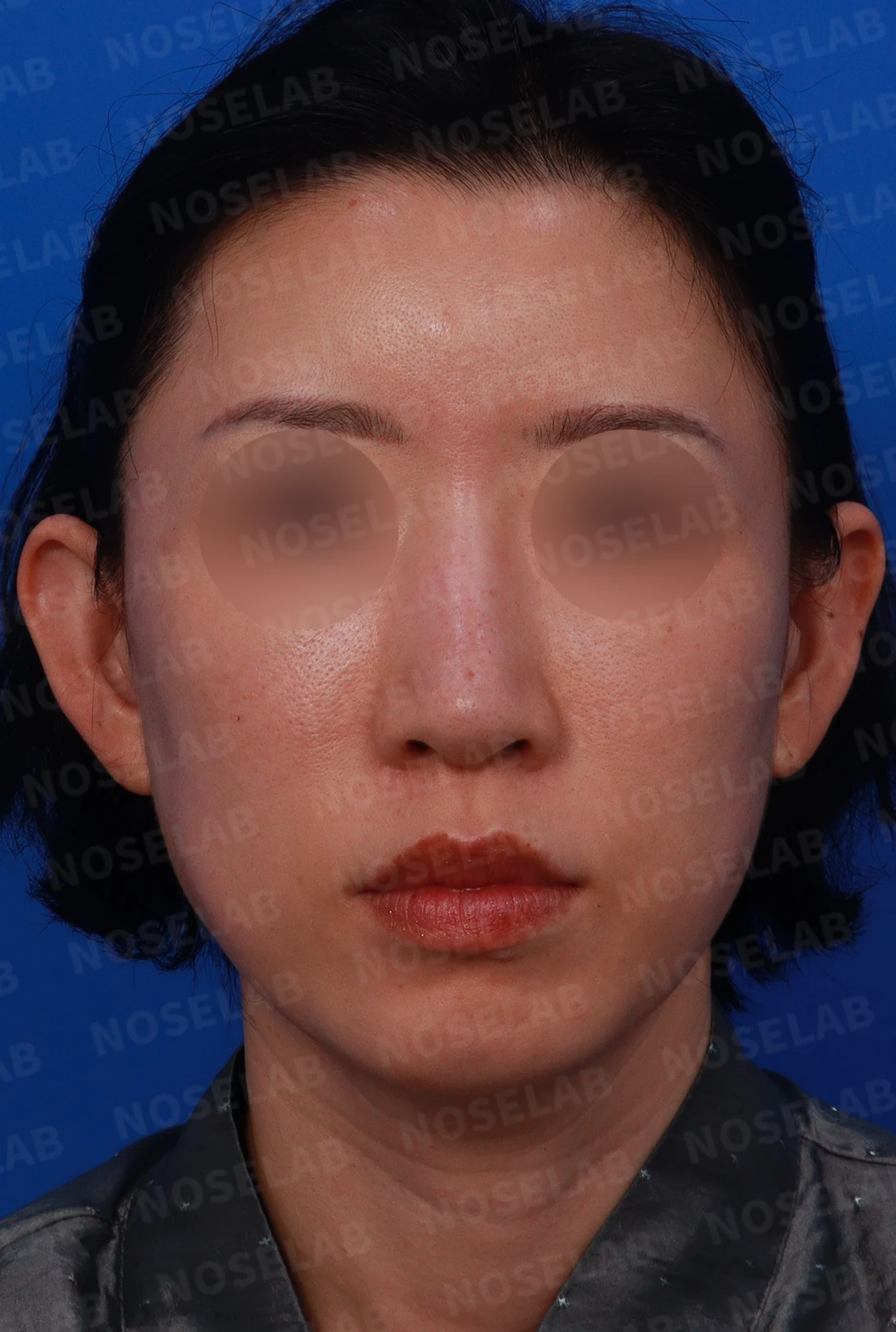 충격을 받은 뒤 코끝에서 소리가 나고 모양이 달라지는 이유와 늑연골 재건 — 디자인 상담 정면 , 좌측 비스듬한 측면 , 측면 사진입니다.