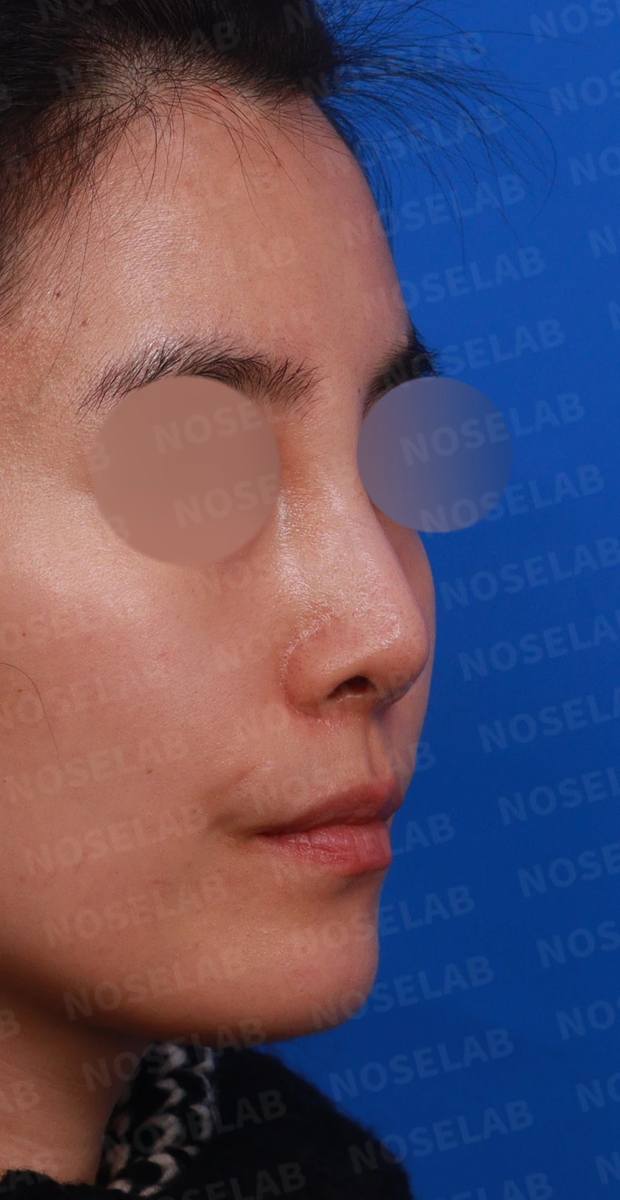 여러 차례 받은 코필러가 남긴 퍼진 코와 코막힘, 어떻게 정리하나 — 디자인 상담 우측 측면, 비스듬한 측면, 비공 사진