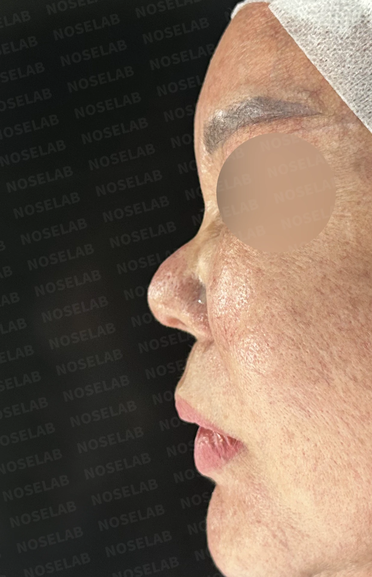 보형물 염증으로 손상된 코, 휴식기 후 기증늑연골로 안전하게 재건한 코재수술 — 전(좌) 직후(후)