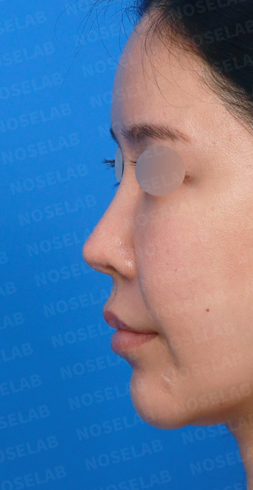 비중격 완전 재건으로 오똑한 코끝과 비공 비대칭 교정 — 디자인 상담 정면, 좌측 측면, 비스듬한 측면 사진입니다.