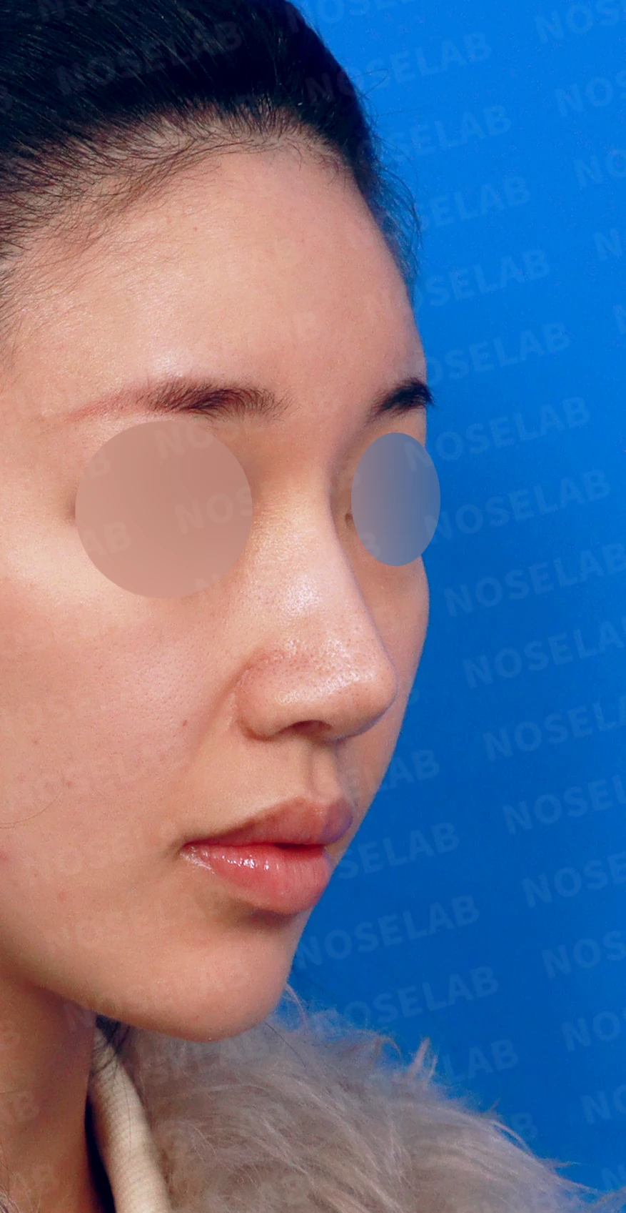 코끝 연골이 피부로 비쳐 보이는 이유와 진피 보강 방법 — 디자인 상담 우측 측면, 비스듬한 측면, 비공 사진입니다.