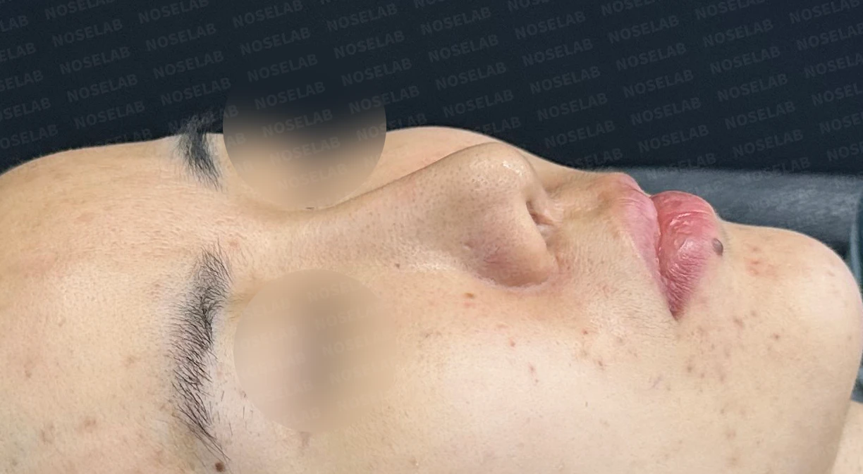 휜코, 뭉툭하고 처진코 수술 사례_대표원장 강차영 — 수술전(좌) 수술직후(우)
