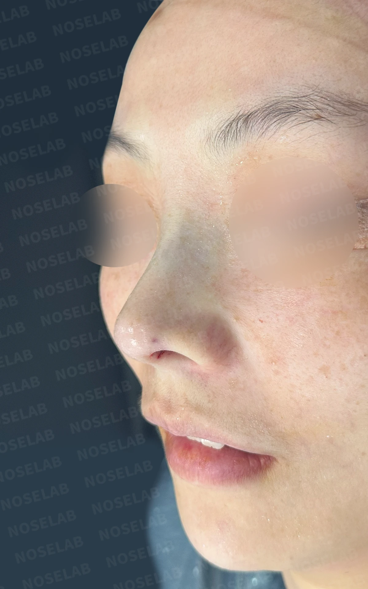 첫 코성형에서 코끝 구조와 콧구멍 노출은 어떻게 다루나 — 수술 전 / 수술 직후 0일 직후 사진은 부기가 있는 상태로 최종 결과와 다를 수 있습니다.
