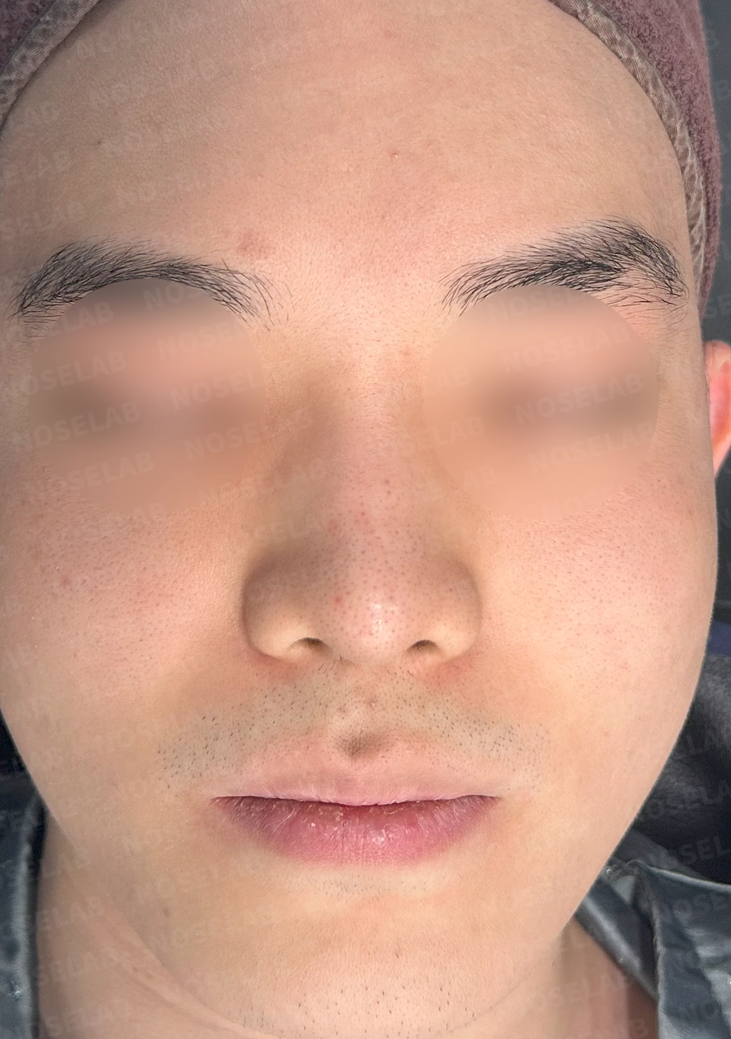 코 실 시술과 지방이식 후 라인이 잡히지 않는 이유, 제거와 늑연골 재건은 어떻게 하나 — 수술 전 / 수술 직후 0일 직후 사진은 부기가 있는 상태로 최종 결과와 다를 수 있습니다.
