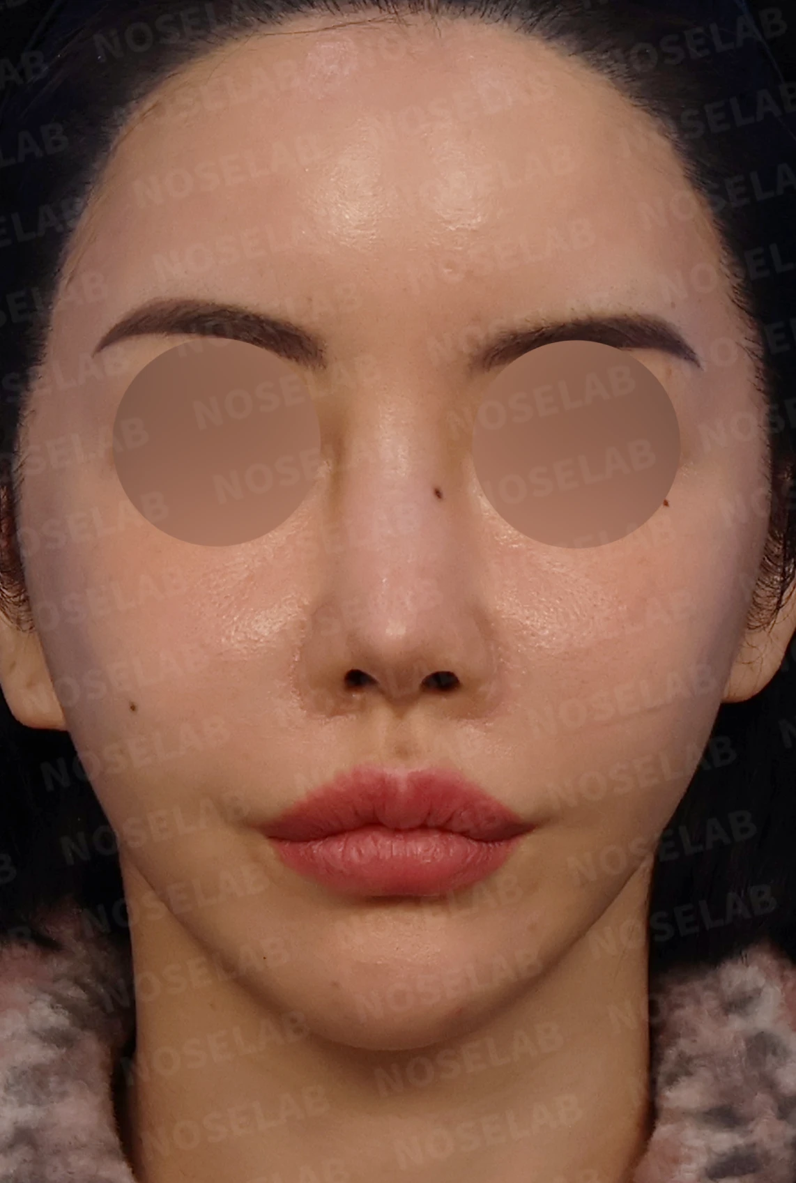 여러 차례 코 수술 뒤 내부 구조가 무너지는 이유와 늑연골 전체 재건 — 디자인 상담 정면, 좌측 측면, 비스듬한 측면 사진입니다