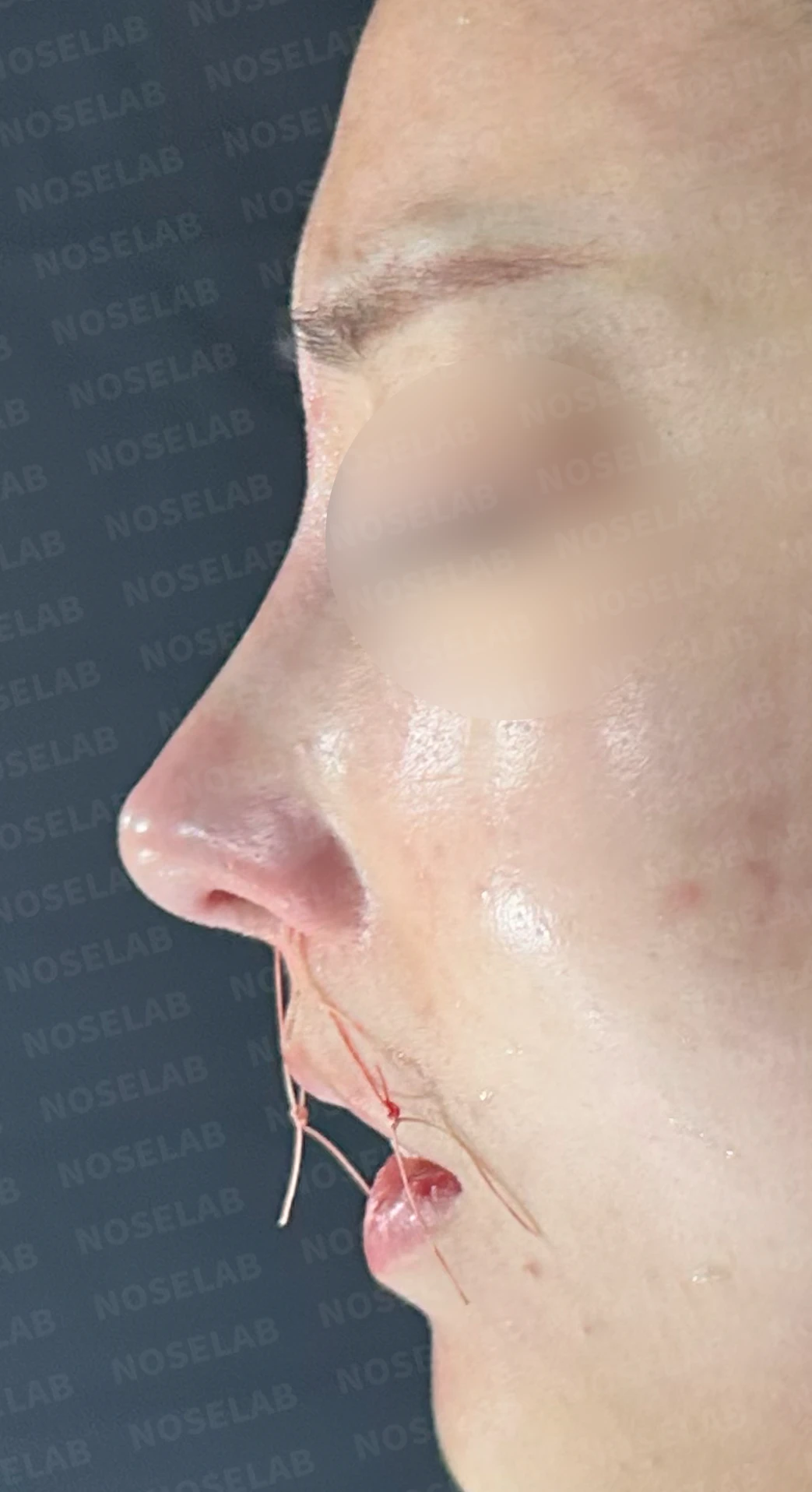휘어진 코 교정과 비염 개선 - 자가늑연골 재건술 후기 — 직후 정면, 비스듬한 측면, 측면 사진입니다.