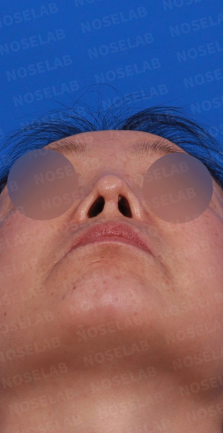 코가 짧고 들리며 비주가 함몰되는 이유, 자가 늑연골 재건은 어떻게 하나 — 본문 사진 4
