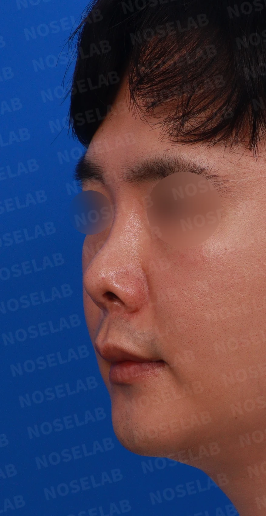 비중격 연골을 많이 쓴 코가 들리고 막히는 이유, 재건은 어떻게 하나 — 디자인 상담 정면 , 좌측 비스듬한 측면 , 측면 사진입니다.