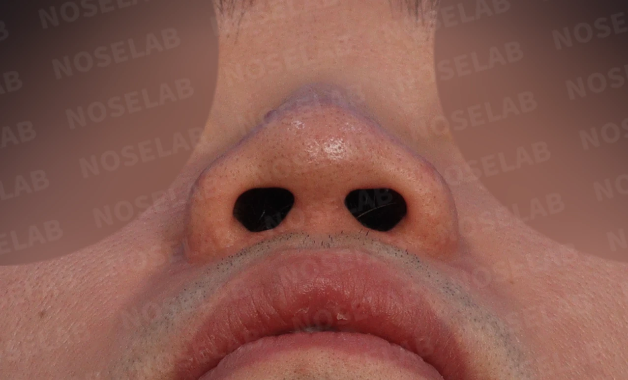 복코와 퍼진 코의 코성형 방법 — 비공 사진입니다.