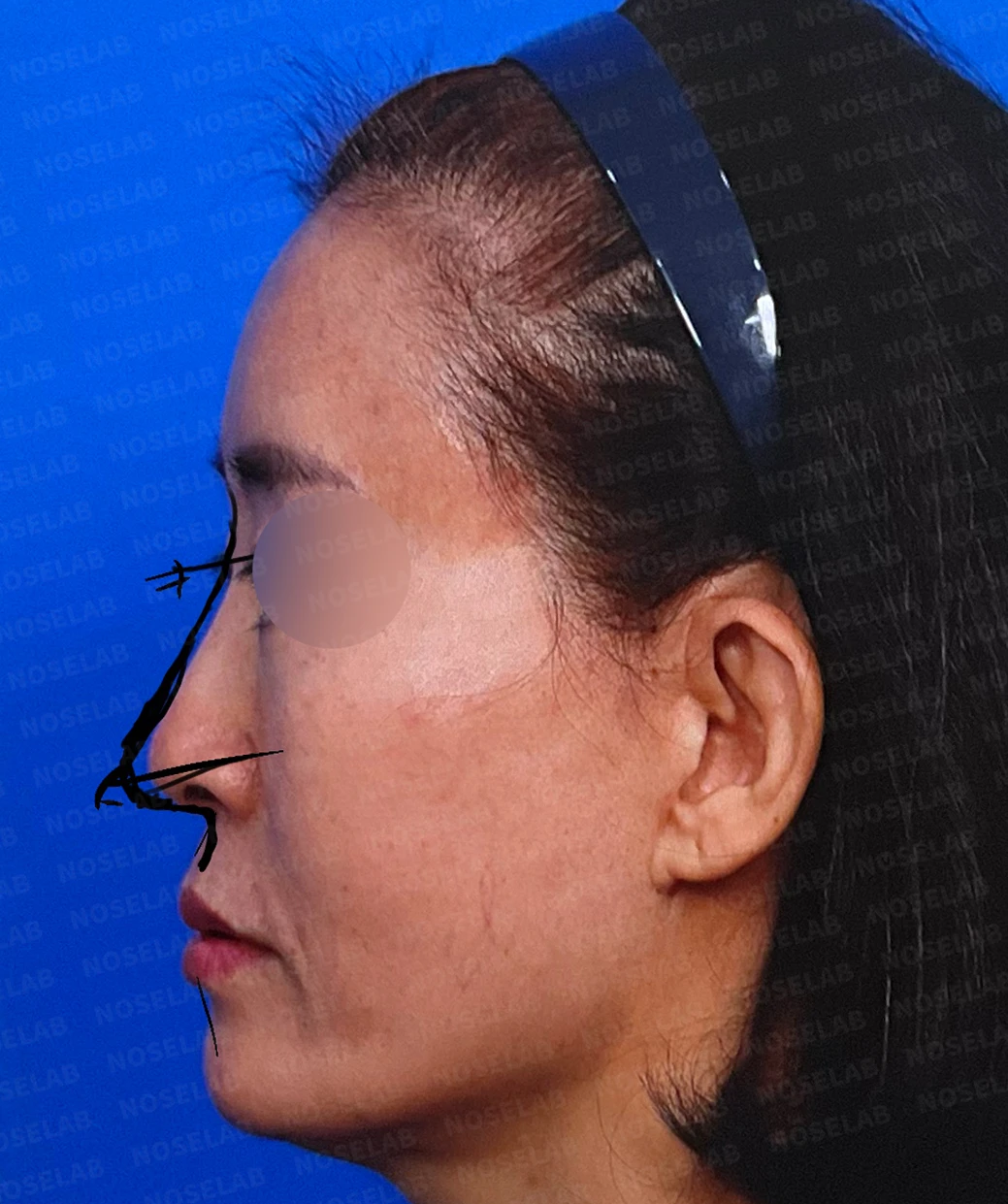 화살코, 긴코 교정 방법 — 수술전 디자인 상담 측면 사진입니다.
