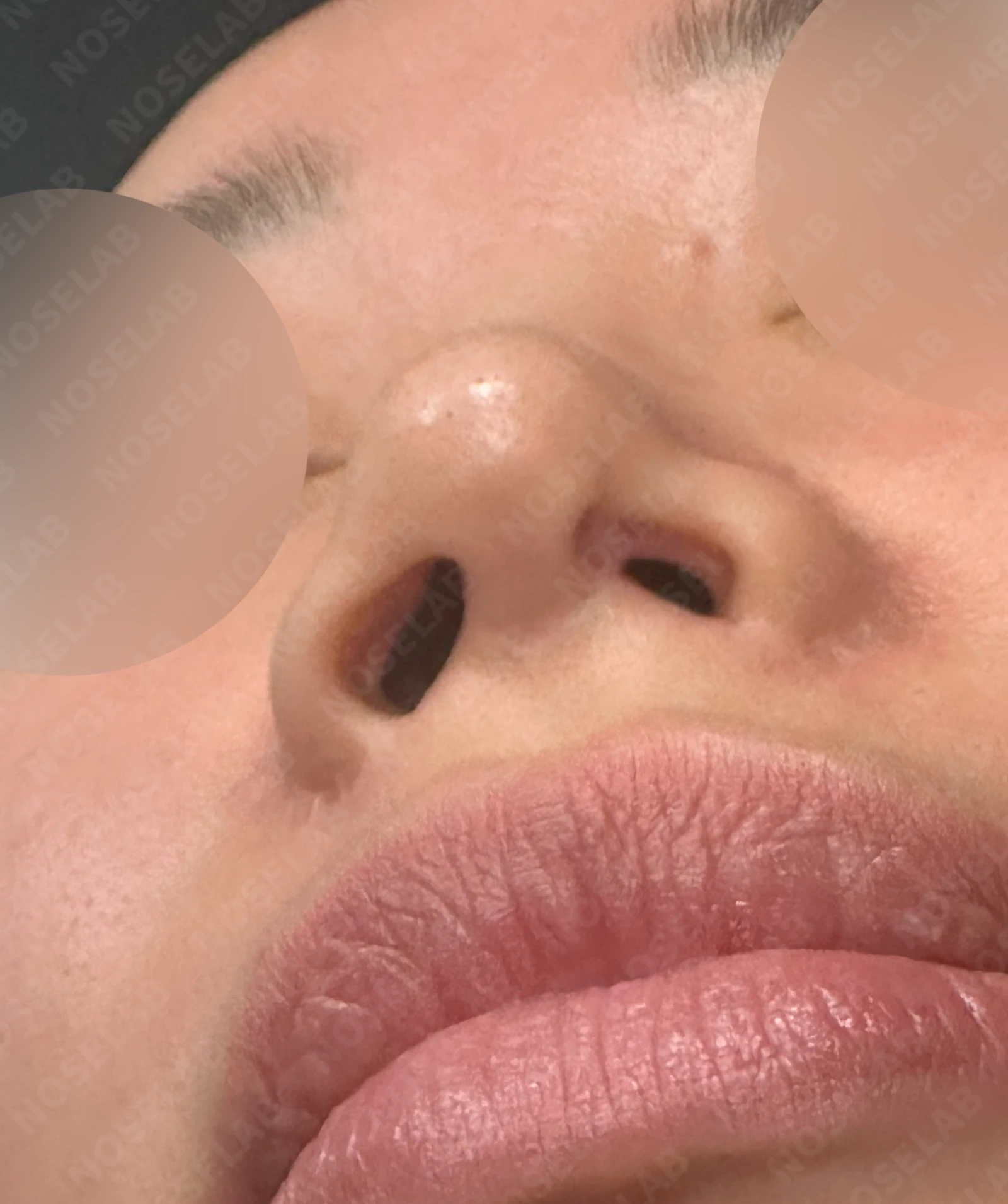 비공협착과 휜코, 코막힘을 함께 살펴보는 재수술 방법 — 수술전 비공 모양과 수술 중 봉합하는 도중 촬영한 비공 사진입니다.