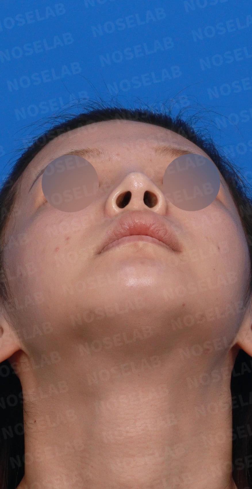 코 시작점이 높고 코끝이 들려 보이는 이유와 교정 방법 — 디자인 상담 우측 측면, 비스듬한 측면, 비공 사진입니다.