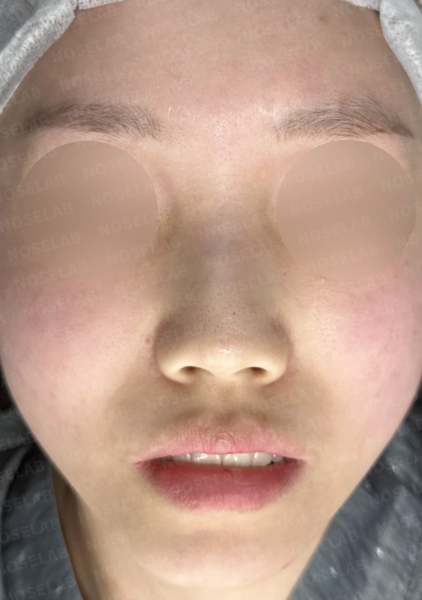 무보형물 코성형, 휘어진 콧대와 처진 코끝을 자연스럽게 교정 — 전(좌) 직후(후)