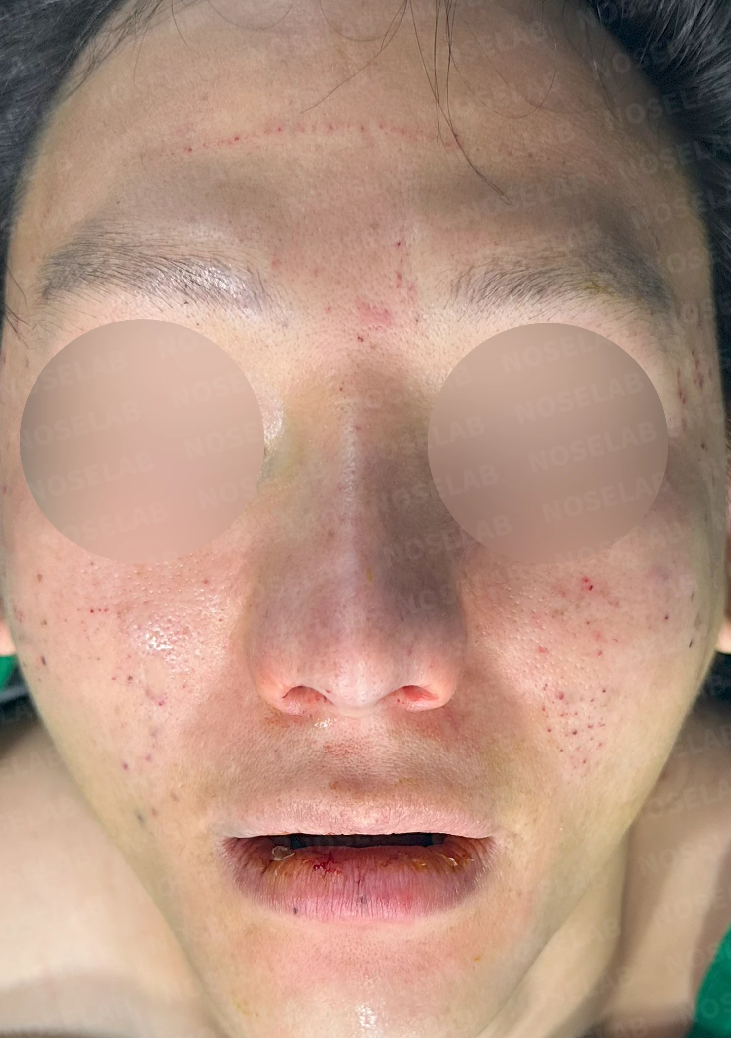 얼굴 비율을 고려한 코성형과 무턱 교정 방법 — 수술 직후 0일 정면, 측면, 비스듬한 측면 사진입니다. 직후 사진은 부기가 있는 상태로 최종 결과와 다를 수 있습니다.