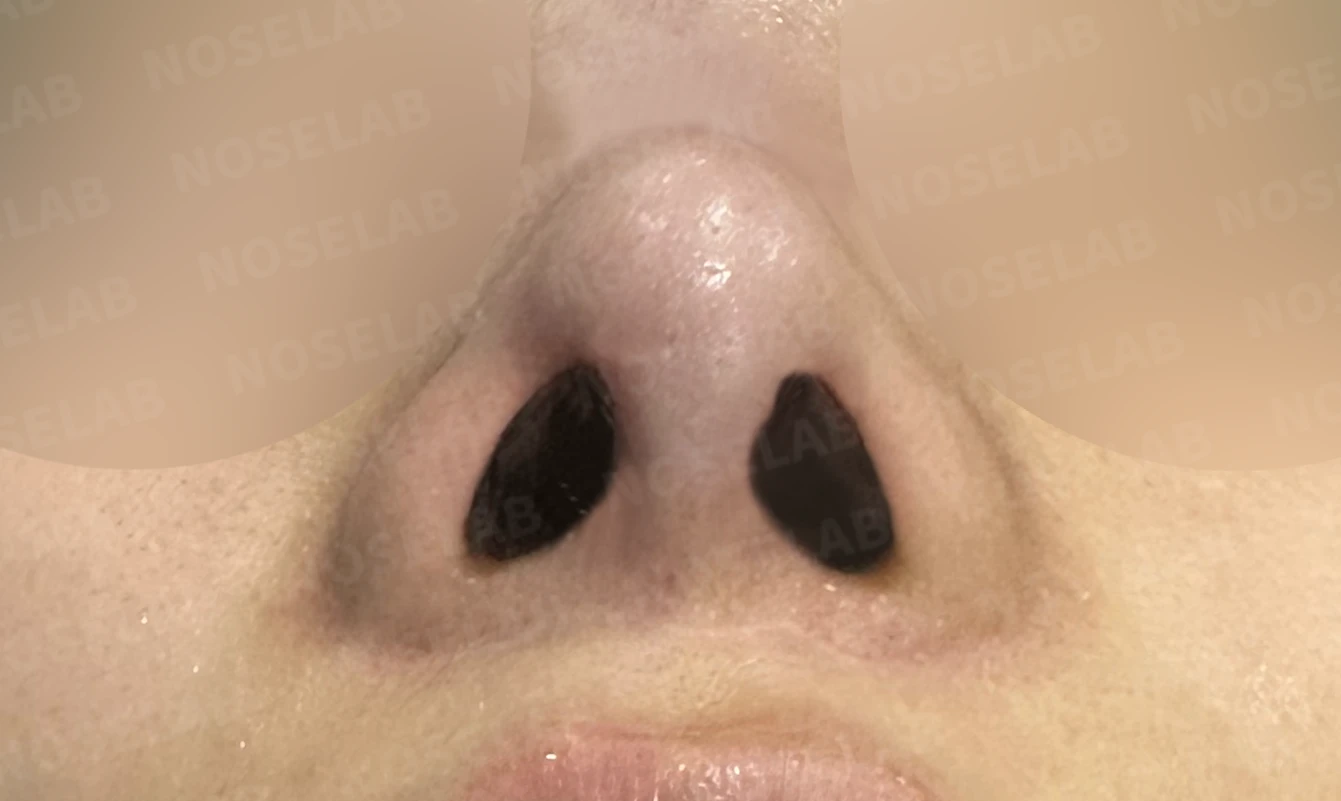 콧대 반영구 필러가 남기는 변화와 제거 후 비중격 재건 — 수술 직후 0일 비공 사진입니다. 직후 사진은 부기가 있는 상태로 최종 결과와 다를 수 있습니다.