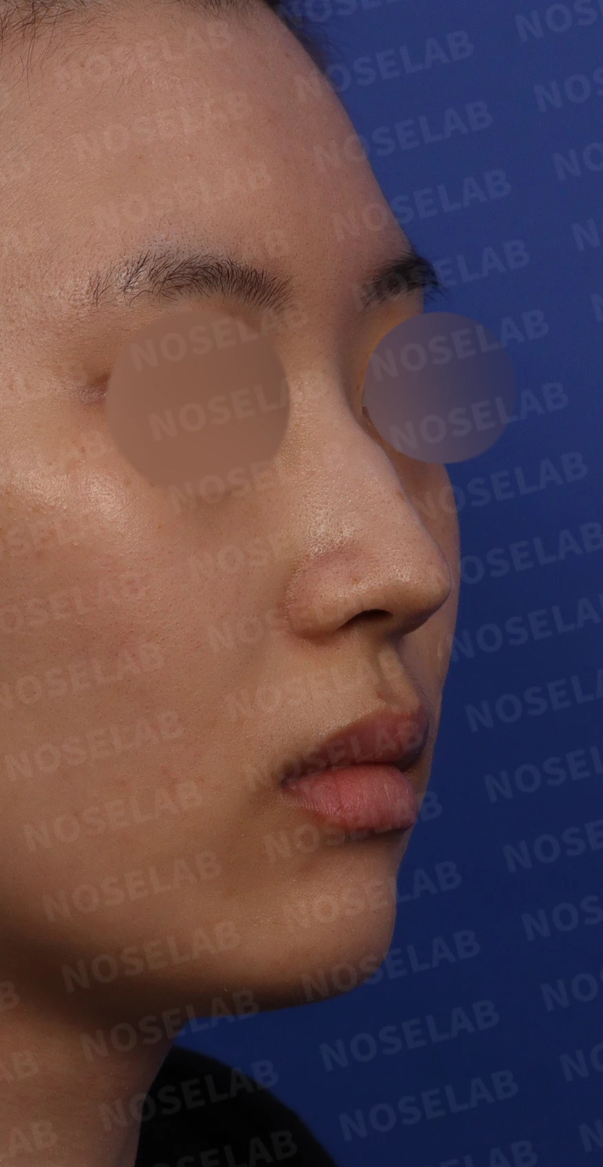 매부리코에 코의 휨과 비공 비대칭이 함께 오는 이유, 비중격 연골 교정은 어떻게 하나 — 디자인 상담 우측 비스듬한 측면, 측면, 비공 사진