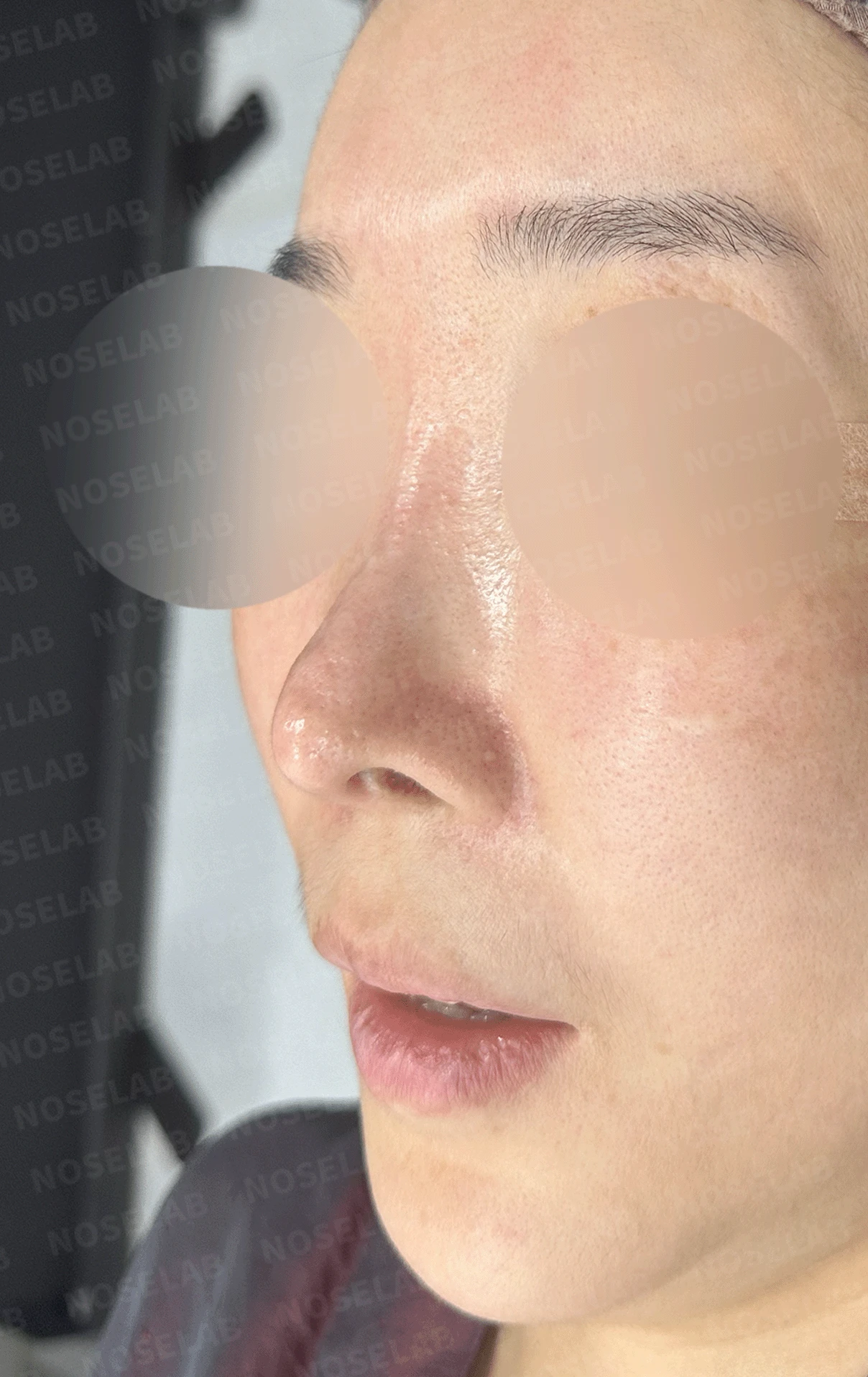 반복된 코재수술 뒤 안장코와 비밸브 협착이 생기는 이유, 전체 재건은 어떻게 하나 — 본문 사진 9