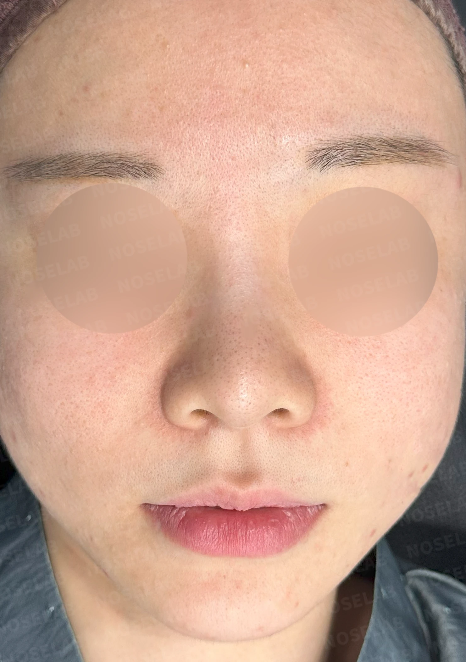 필러와 실 시술 뒤 코가 뭉툭해지는 이유, 이물질 제거와 코끝 교정 방법 — 수술 전 / 수술 직후 0일 직후 사진은 부기가 있는 상태로 최종 결과와 다를 수 있습니다.