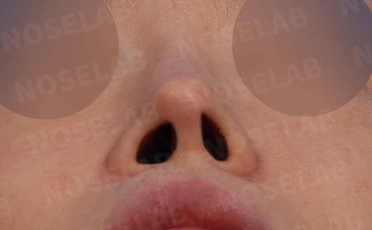 휜 코, 콧구멍 비대칭 교정 코재수술 사례 — 전후 비교