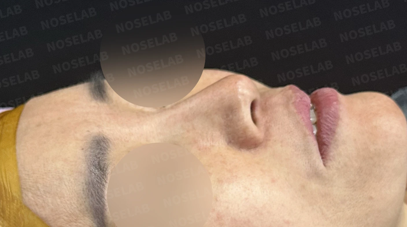 화살코, 긴코 교정 방법 — 수술 전 / 수술 직후 0일 직후 사진은 부기가 있는 상태로 최종 결과와 다를 수 있습니다.