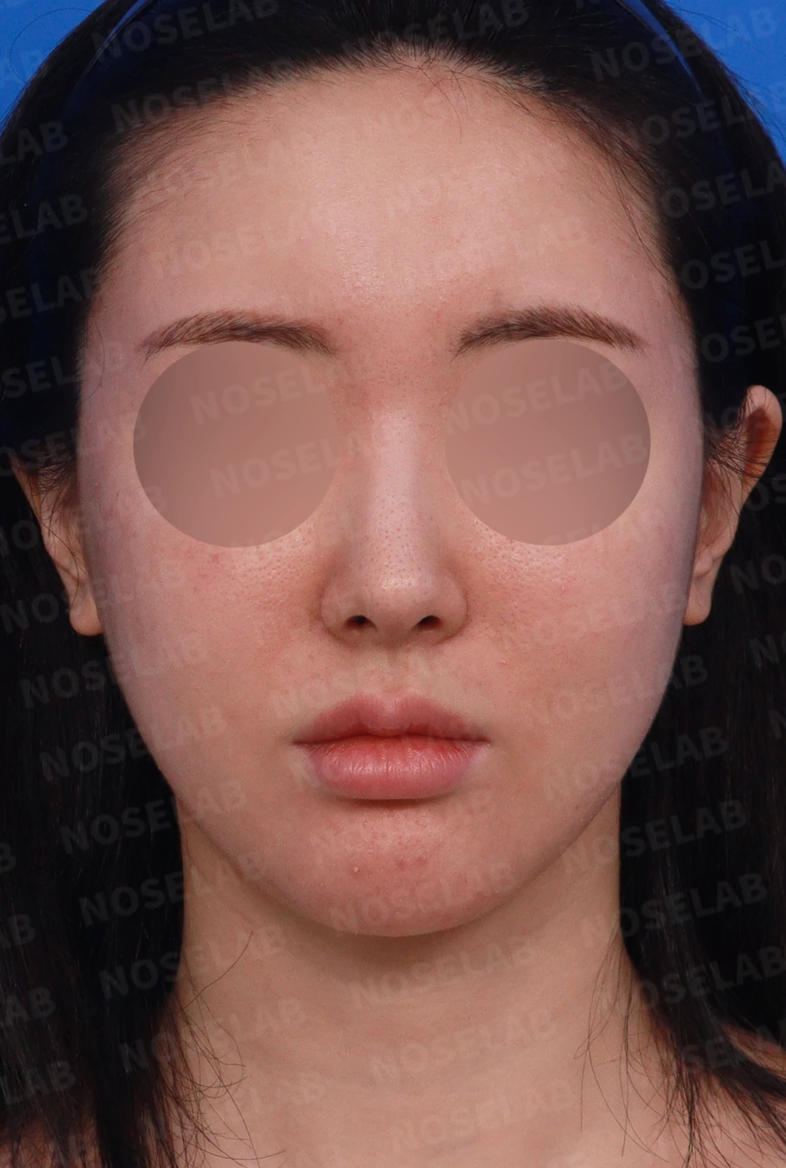 코가 길어 보이고 비주가 휘는 이유, 비중격 연장과 재건은 어떻게 하나 — 디자인 상담 정면, 좌측 측면, 비스듬한 측면 사진