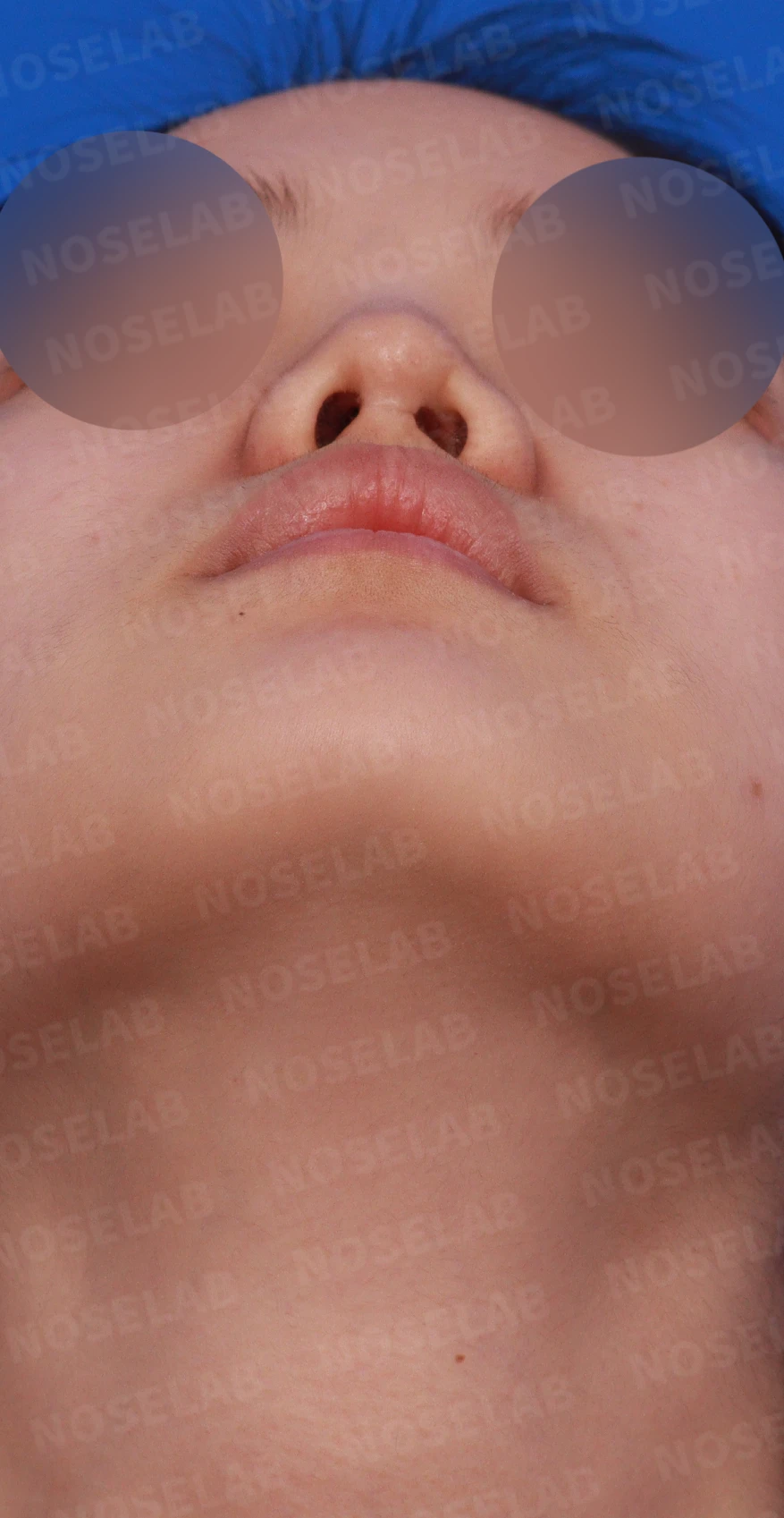 이전 수술 뒤 콧구멍이 좁아지는 비공협착, 원인과 재건 방법 — 디자인 상담 우측 측면, 비스듬한 측면, 비공 사진입니다.