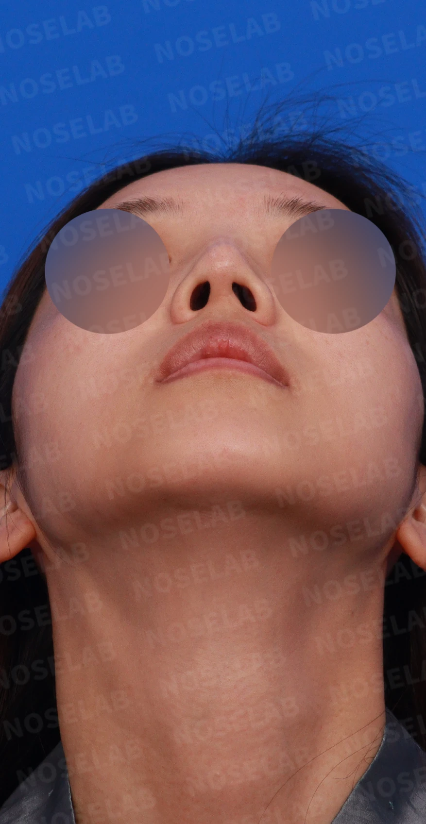 실리콘 부작용 후 자가늑연골로 재건하는 방법 — 우측 비스듬한 측면, 측면, 비공 사진