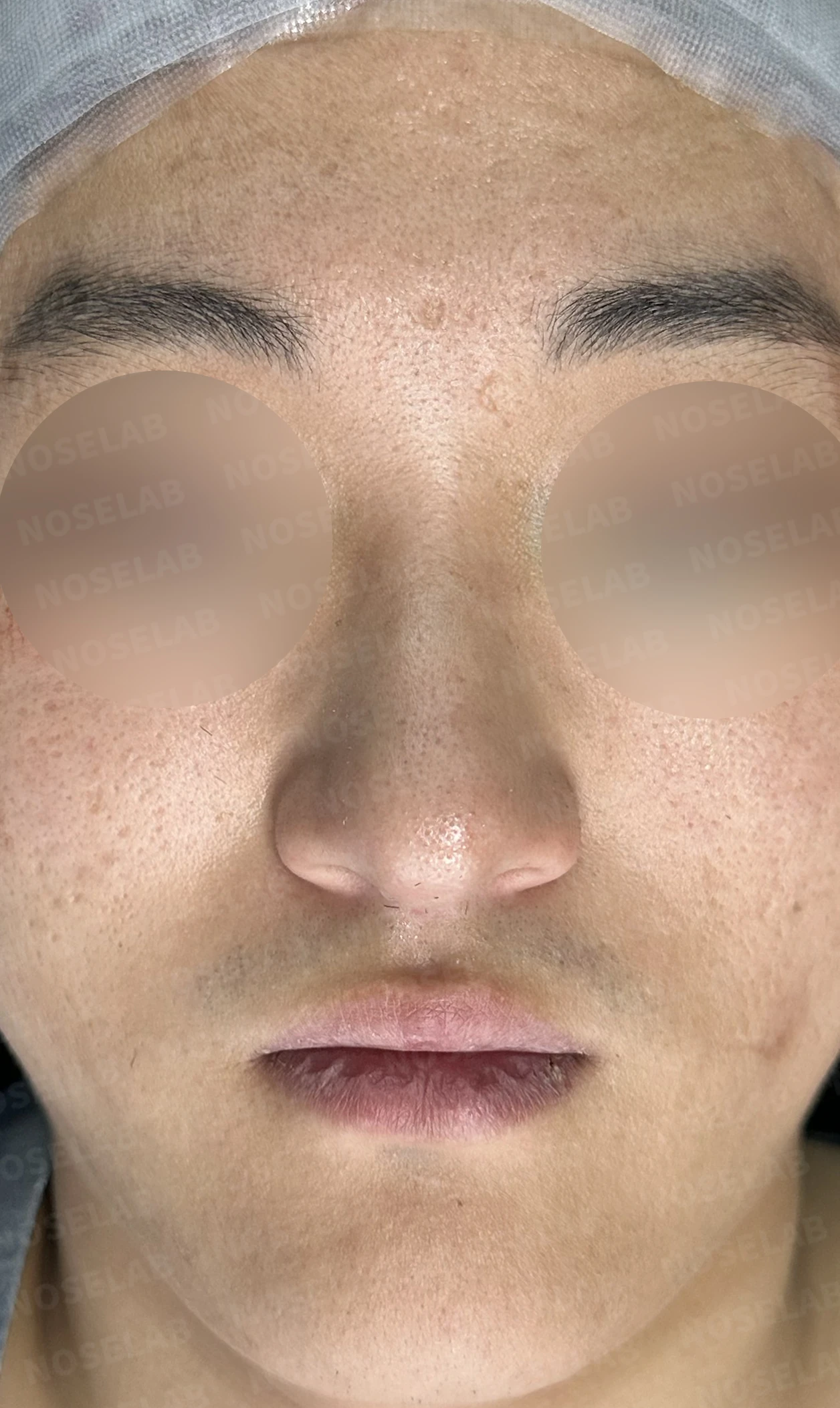 휜코 교정하면 안면 비대칭이 좋아질까요? — 수술 전 / 수술 직후 0일 직후 사진은 부기가 있는 상태로 최종 결과와 다를 수 있습니다.