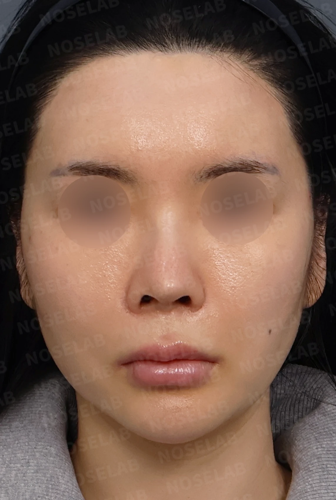 여러 차례 수술 뒤 코막힘이 남는 이유, 비중격과 비밸브 재건은 어떻게 하나 — 디자인 상담 정면, 좌측 측면, 비스듬한 측면 사진입니다.