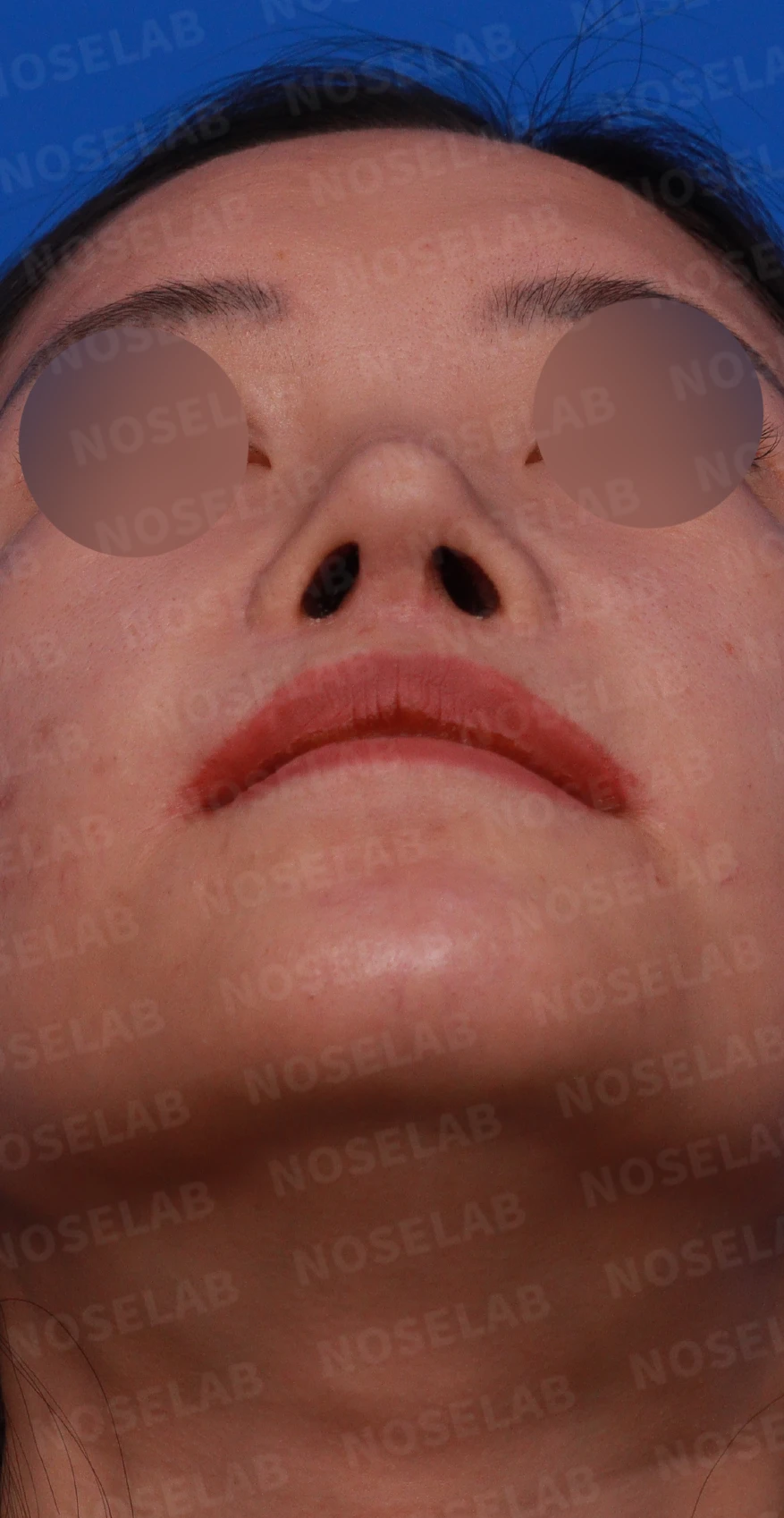 원하는 코 모양과 현재 구조를 함께 살펴보는 수술 계획 — 디자인 상담 우측 측면, 비스듬한 측면, 비공 사진입니다.