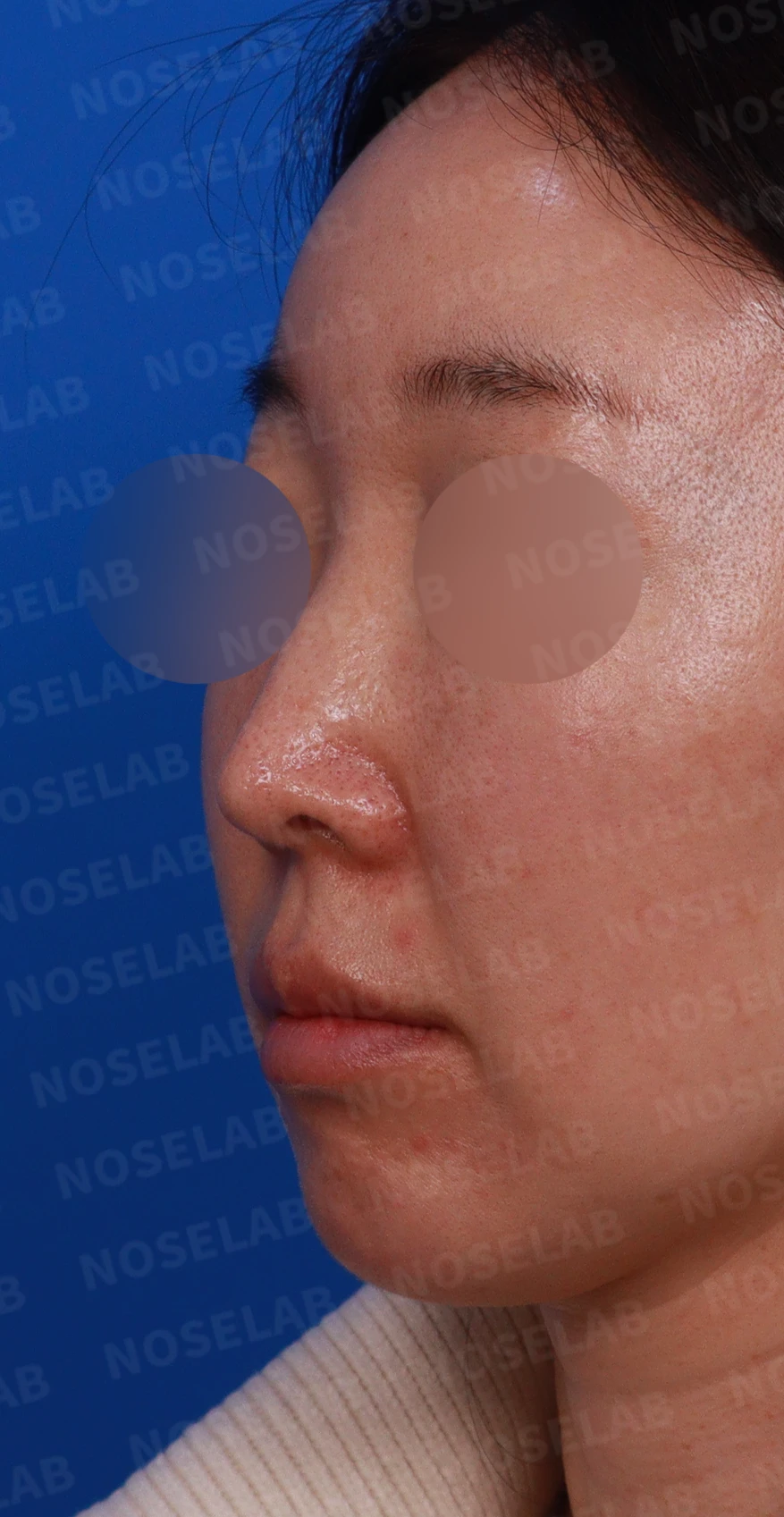 긴 코와 퍼진 콧대의 재수술 방법 — 디자인 상담 정면, 좌측 비스듬한 측면, 측면 사진