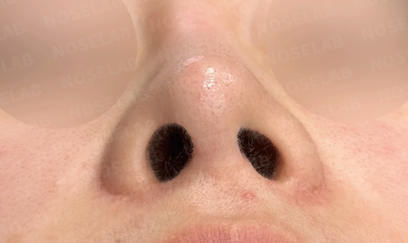 콧대가 인위적으로 보이고 코가 들리는 이유, 재건은 어떻게 하나 — 본문 사진 13