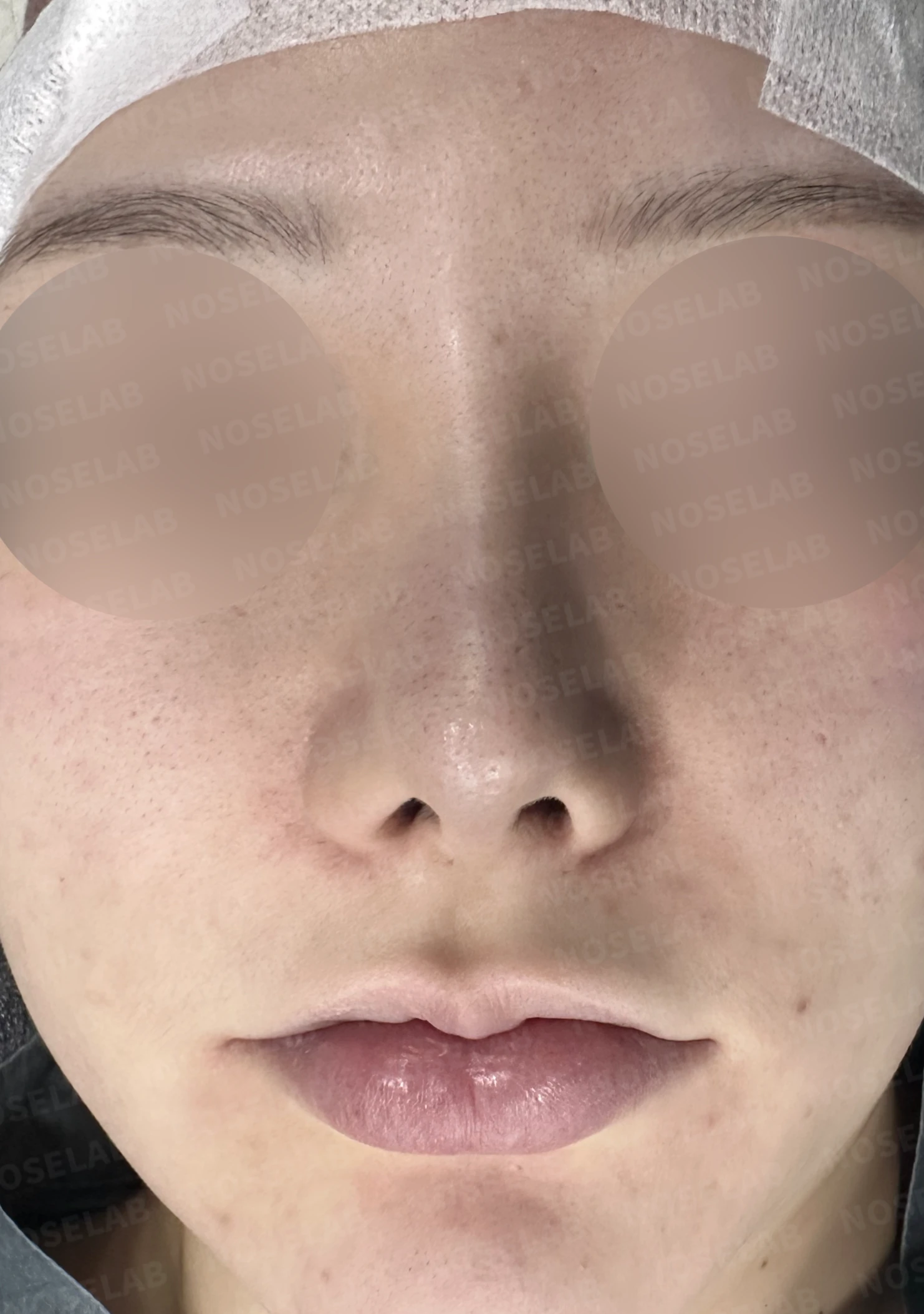 휘어진 코와 비공 비대칭, 자가늑연골 비중격 재건으로 완성한 코재수술 — 전(좌) 직후(후)