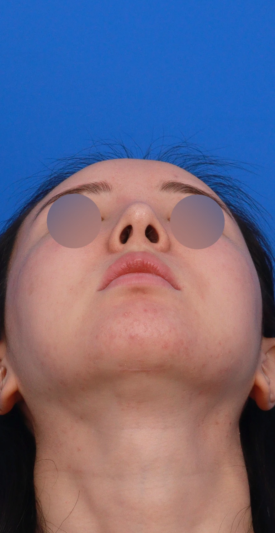 코가 길어 보이고 비주가 휘는 이유, 비중격 연장과 재건은 어떻게 하나 — 디자인 상담 우측 측면, 비스듬한 측면, 비공 사진